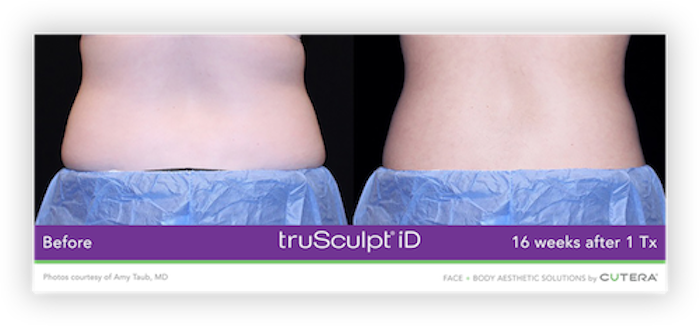 truSculpt® iD Before After 3